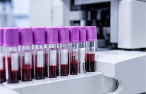 CBC medical laboratory test photograph