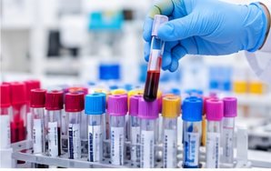 HIV medical laboratory test photograph