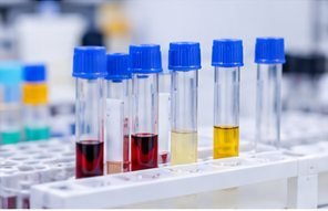 PSA medical laboratory test photograph